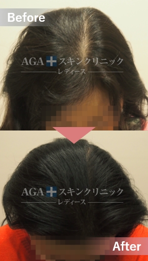 リバースレディ＋Dr’sメソ|前頭部・生え際の薄毛治療症例|50代女性