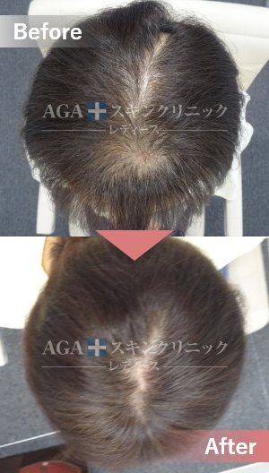 リバースレディ＋Dr’sメソ|頭頂部・つむじの薄毛治療症例|50代女性